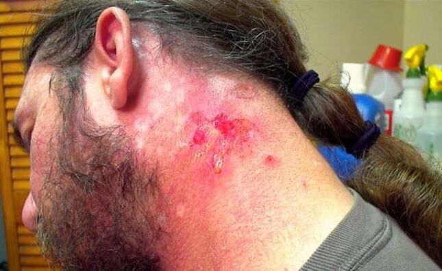 Bloody neck wound with Morgellons virus