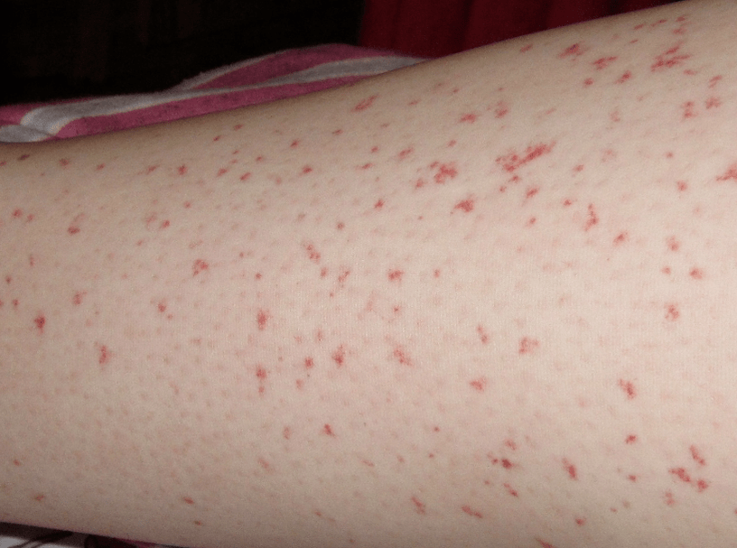 The rash is a sign of an acute stage of worm infection